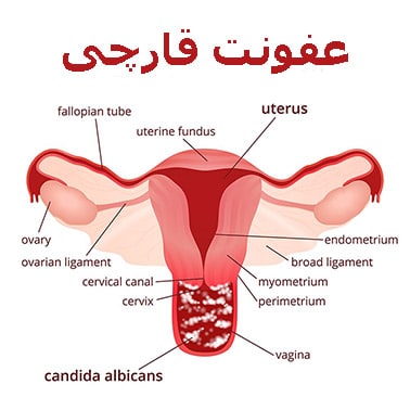 عفونت قارچی واژن